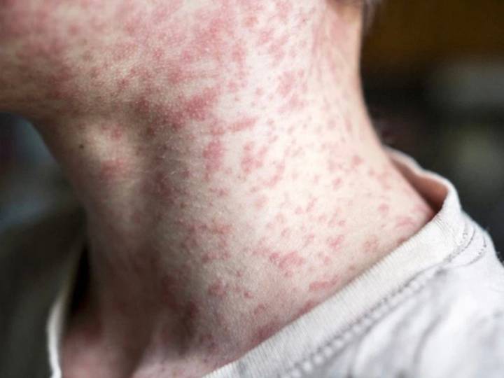 AHS issues public alert after potential measles in Edmonton