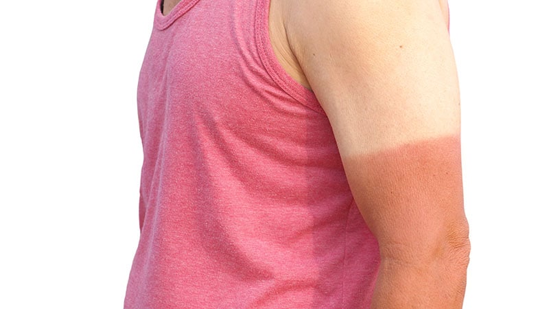 Skin Not Canvas: Deadly Sun Tattoo Craze