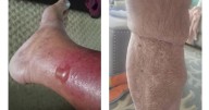 How to protect yourself from Vibrio vulnificus, the bacteria found in some coastal waters