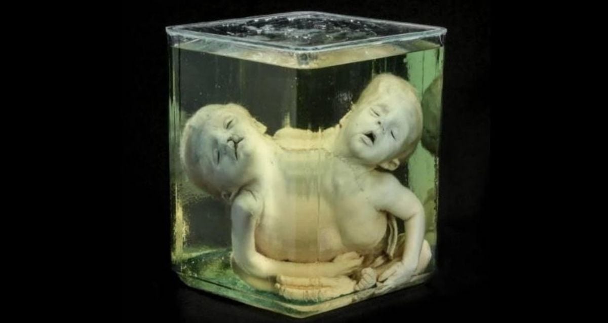The Mütter Museum's 44 Most Curious Medical Oddities