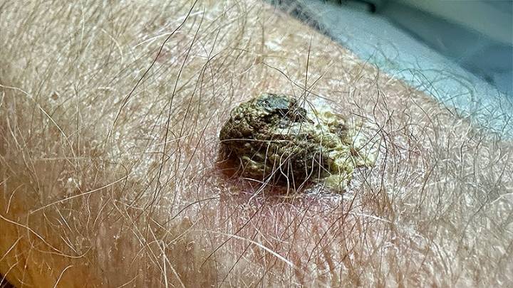 Cemiplimab Extends Disease-Free Time in Skin Cancer Post