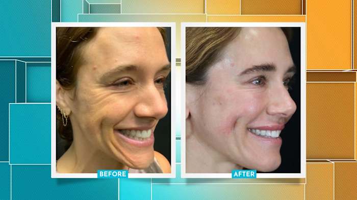 No surgery, all glow: How Houston’s filler experts deliver natural, long
