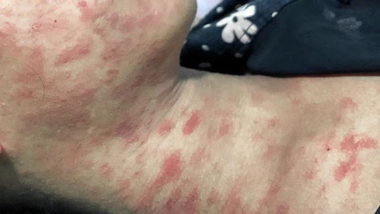 Alarma en China: 7 mil personas contagiadas de chikungunya