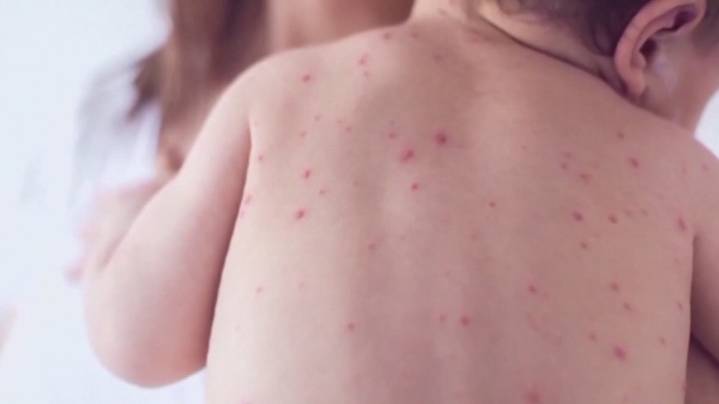 Second Idaho resident measles case confirmed in unvaccinated child