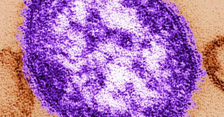 Wisconsin Department of Health Services confirms first cases of measles in Wisconsin this year