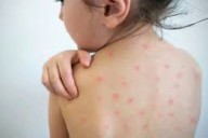 Posible muerte por sarampión: Someten a menor a pruebas de laboratorio