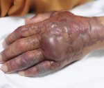 New Yorkers Face Growing Threat From Deadly Flesh