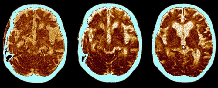 A Routine Vaccine May Lower Dementia Risk by as Much as 20%