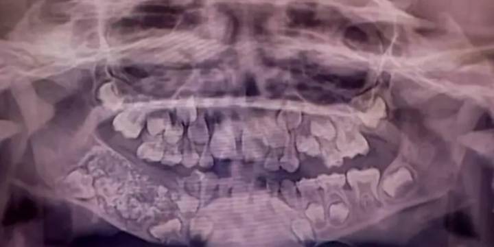 El increíble caso del niño al que le extrajeron 526 dientes en una sola cirugía