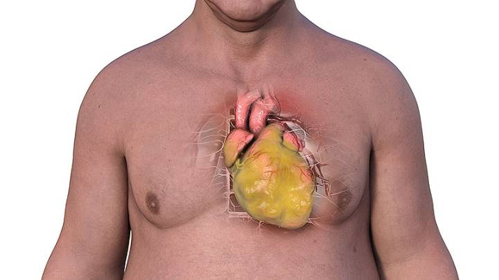 High Fat Around Heart Signals Risk for New AFib