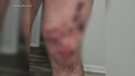 Man bitten by bull shark while spearfishing off Pensacola shares survival story 