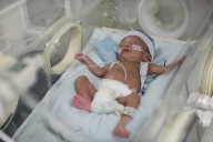 Intranasal Stem Cell Therapy Promising in Babies with Brain Injury