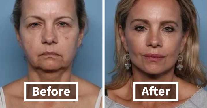 “Went From A Mom At Costco To Beverly Hills Housewife”: 80 Before And After Plastic Surgery Pics