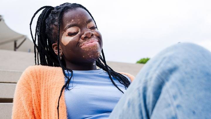 Race, Ethnicity Influences Depression Risk in Vitiligo
