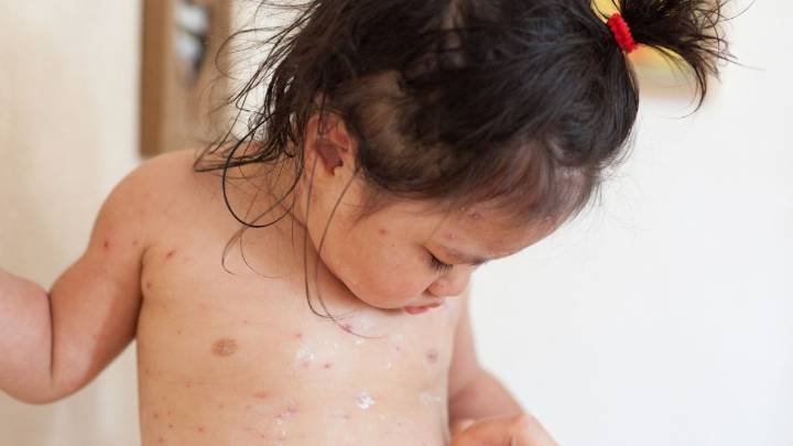 Free chickenpox vaccination to be offered to children in England from January
