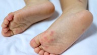 The highly contagious summer illness parents of young kids need to know about
