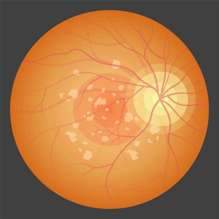 Extension of PULSAR Shows Durable Improvement From Eylea HD For Wet AMD