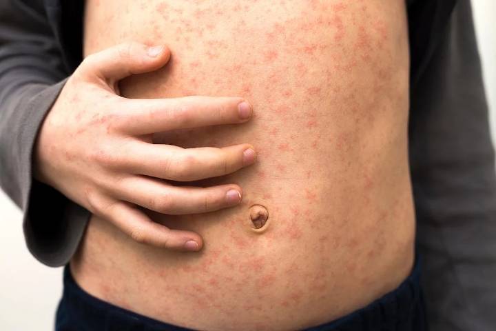Measles Outbreak in Texas Is Over After Hundreds Infected and 2 Deaths