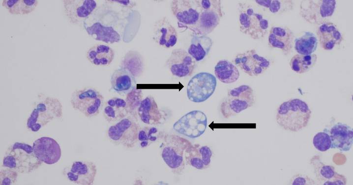 Missouri patient contracts 'brain-eating' amoeba after waterskiing in Lake of the Ozarks