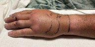 Warning of rattlesnake bites as heat, dryness lead to more encounters
