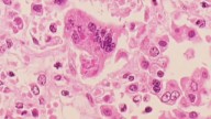 Possible measles exposure: Health officials warn of infected traveler