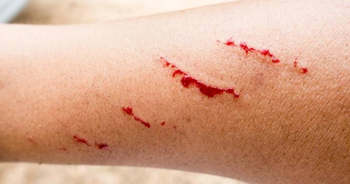 Rabia en Zacatecas: joven de 17 años da positivo tras mordedura de animal silvestre