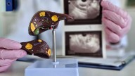 Novel Lipogenesis Inhibitor Combo Effective Against MASH