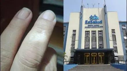 Paciente con vitíligo no recibe tratamiento hace siete meses por equipo malogrado de fototerapia