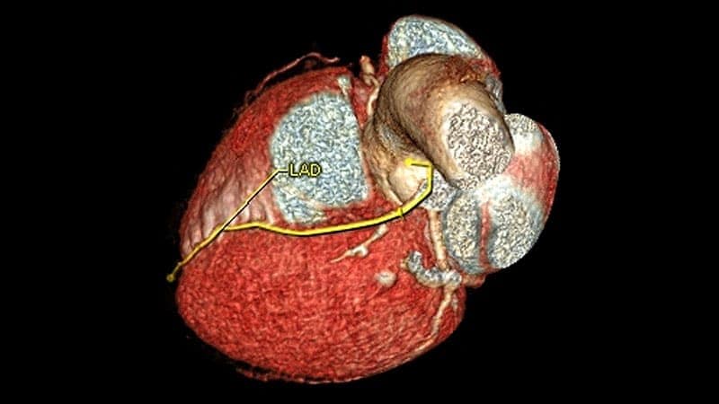 ¿Cuál es la mejor estrategia para modificar la placa coronaria calcificada?