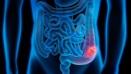 Oxaliplatin’s Benefit in CRC: Is There an Age Threshold?