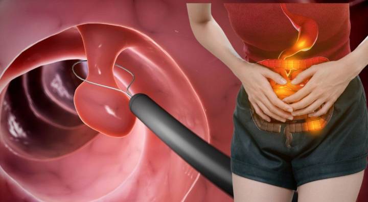 Pólipos en el colon: síntomas, causas y cuándo hay riesgo de cáncer