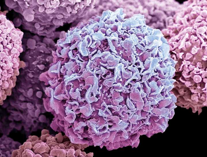Triple-Negative Breast Cancer Mutations Mapped in Black Women