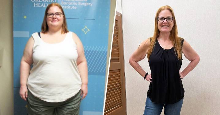 Duodenal Switch Weight Loss Surgery Helps Woman Lose 220 Pounds