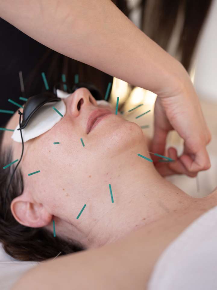 ¿La acupuntura estética puede ser el nuevo bótox?