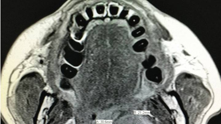 Is Cisplatin-Sparing Tx Beneficial in Nasopharyngeal Cancer?