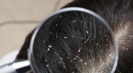 ¿Por qué sale caspa en el cabello? Causas y tratamientos