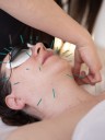 ¿La acupuntura estética puede ser el nuevo bótox?