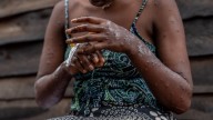 Why one doctor says we're 'walking blind' in the mpox emergency