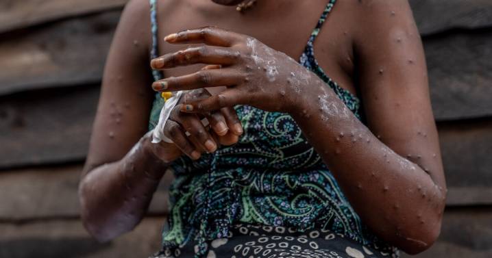 Why one doctor says we're 'walking blind' in the mpox emergency
