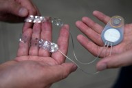 This electric brain implant could help stroke victims recover. The first patient: A Seattle