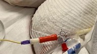 Joven madre se queda sin piel en el 95% su cuerpo a causa del ibuprofeno