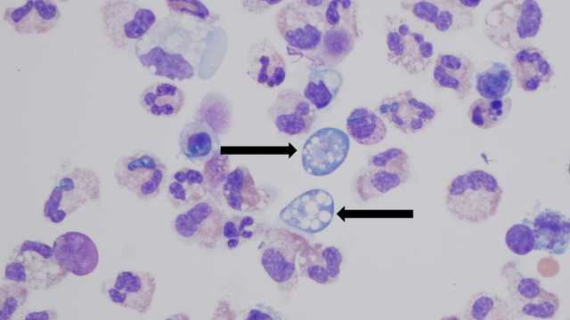 Missouri 'brain-eating' amoeba patient dies after Lake of the Ozarks trip