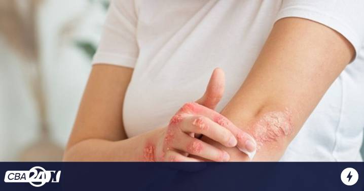 Córdoba se suma a la campaña nacional de detección gratuita de enfermedad psoriásica