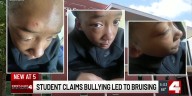 Hazelwood middle school fight leaves student with scar and swollen eye after alleged bullying