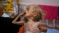 Malnourished kids arrive daily at a Gaza hospital as Netanyahu denies hunger