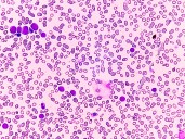 Cancer Therapies May Advance with Understanding of CTNA Resistance Mechanisms