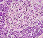 Type 1 Diabetic Produces His Own Insulin After Gene