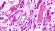Why a rare blood cancer has become a testing ground for cancer drug innovation