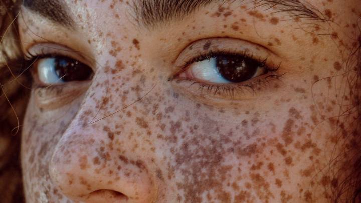 How Radio Frequency Devices Can Stimulate Collagen Production