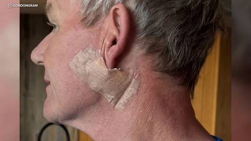 Celebrity chef Gordon Ramsay undergoes surgery to remove skin cancer near ear
